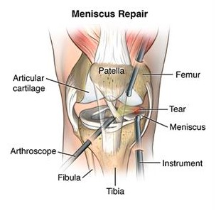 Medical-Condition: Torn meniscus - How is torn meniscus treated