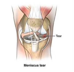 Medical-Condition: Torn meniscus - What causes a torn meniscus