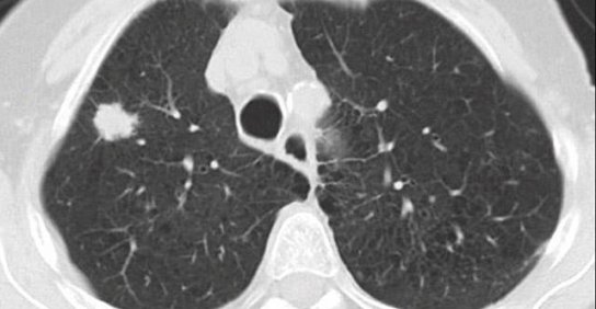 x-ray image on lungs