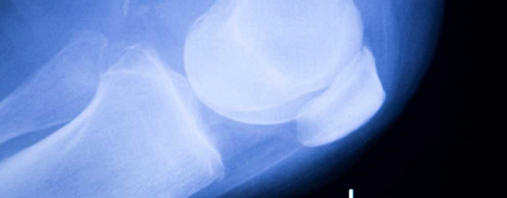 Image of xray of knee